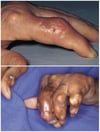 Tophi in the Fingers