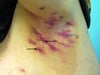 Severe Hidradenitis Suppurativa