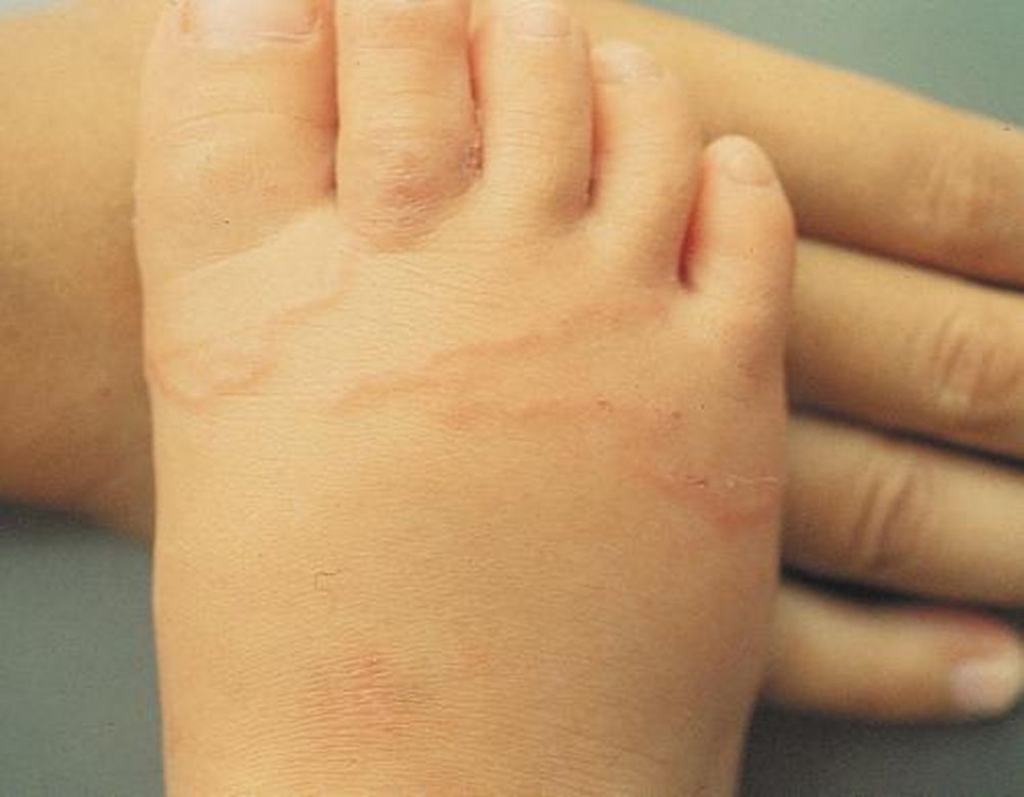 발에 나타난 피부 유충 이행증