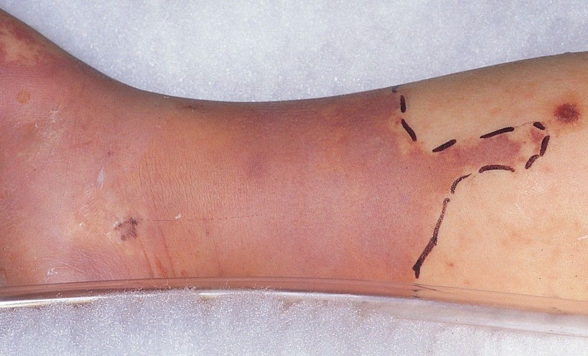 Cellulitis Due to Bacterial Infection