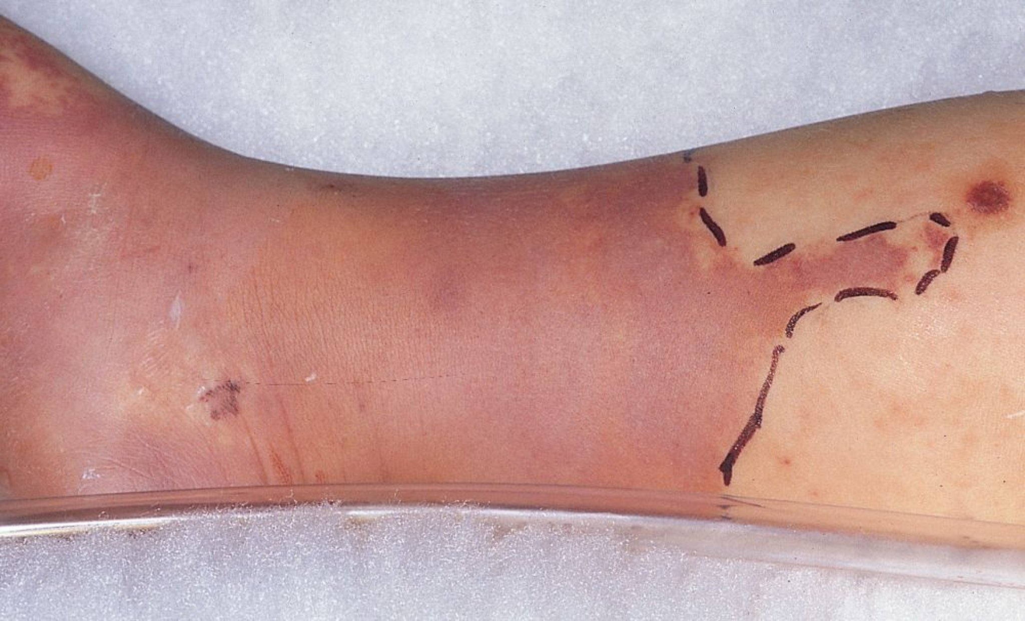 Cellulite due à une infection bactérienne