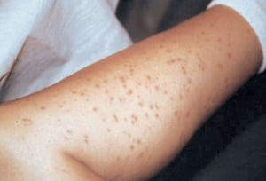 Urticária pigmentosa (perna)