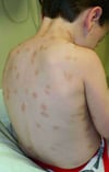 Urticaria pigmentosa (niño)