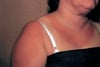 Urticaire solaire