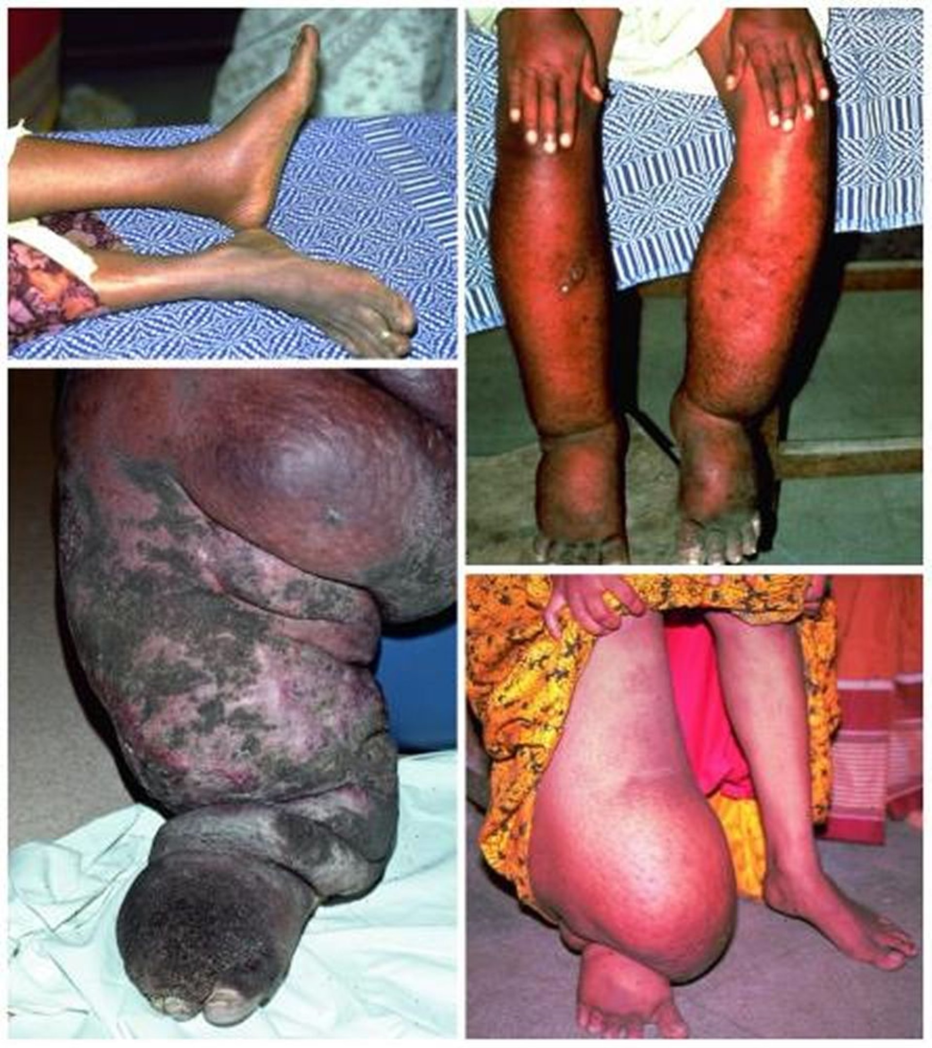 Повреждение кожи при филяриозе