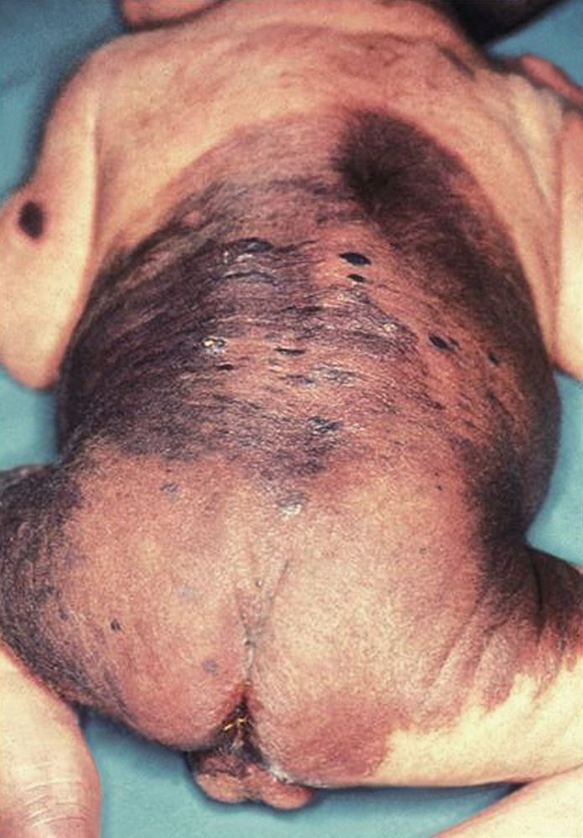 Nevo melanocitico congenito
