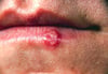Herpes labiale
