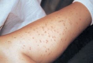 Urticaria Pigmentosa (Leg)