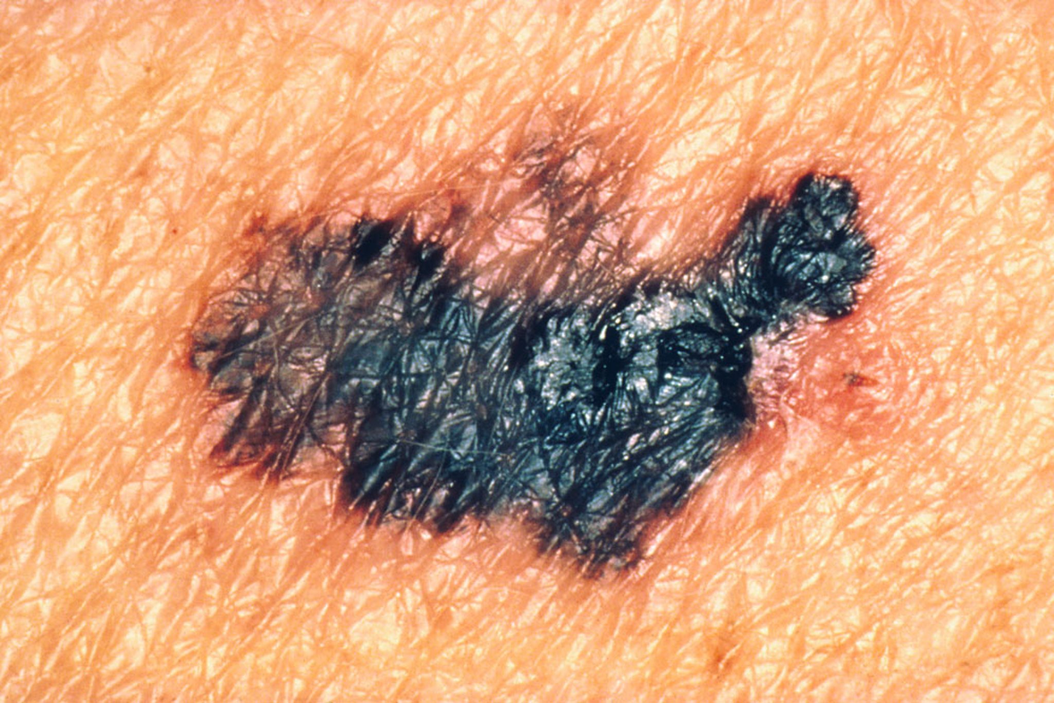 Melanoma (2)