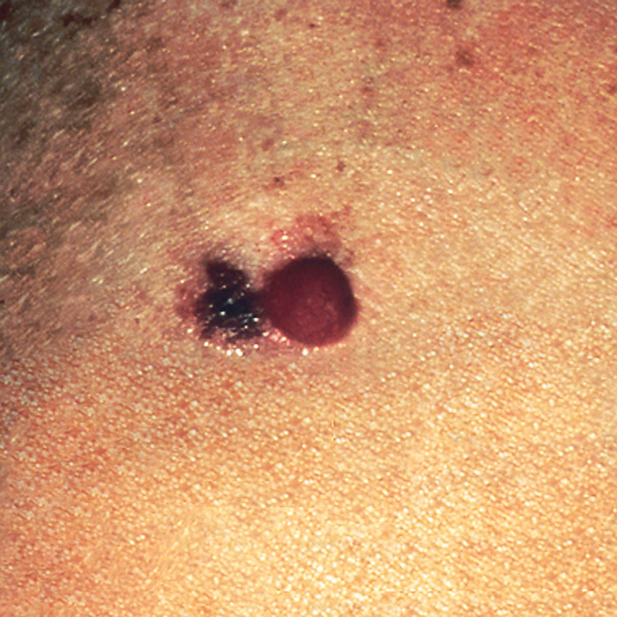 Mixed Melanoma