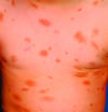 Urticaria Pigmentosa (Kifua)