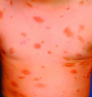 Urticaria Pigmentosa (Chest)