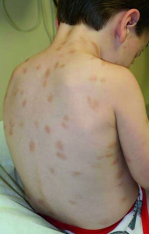 Urticaria Pigmentosa (Mtoto)