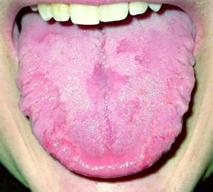 Geographic Tongue (With Fissured Tongue)