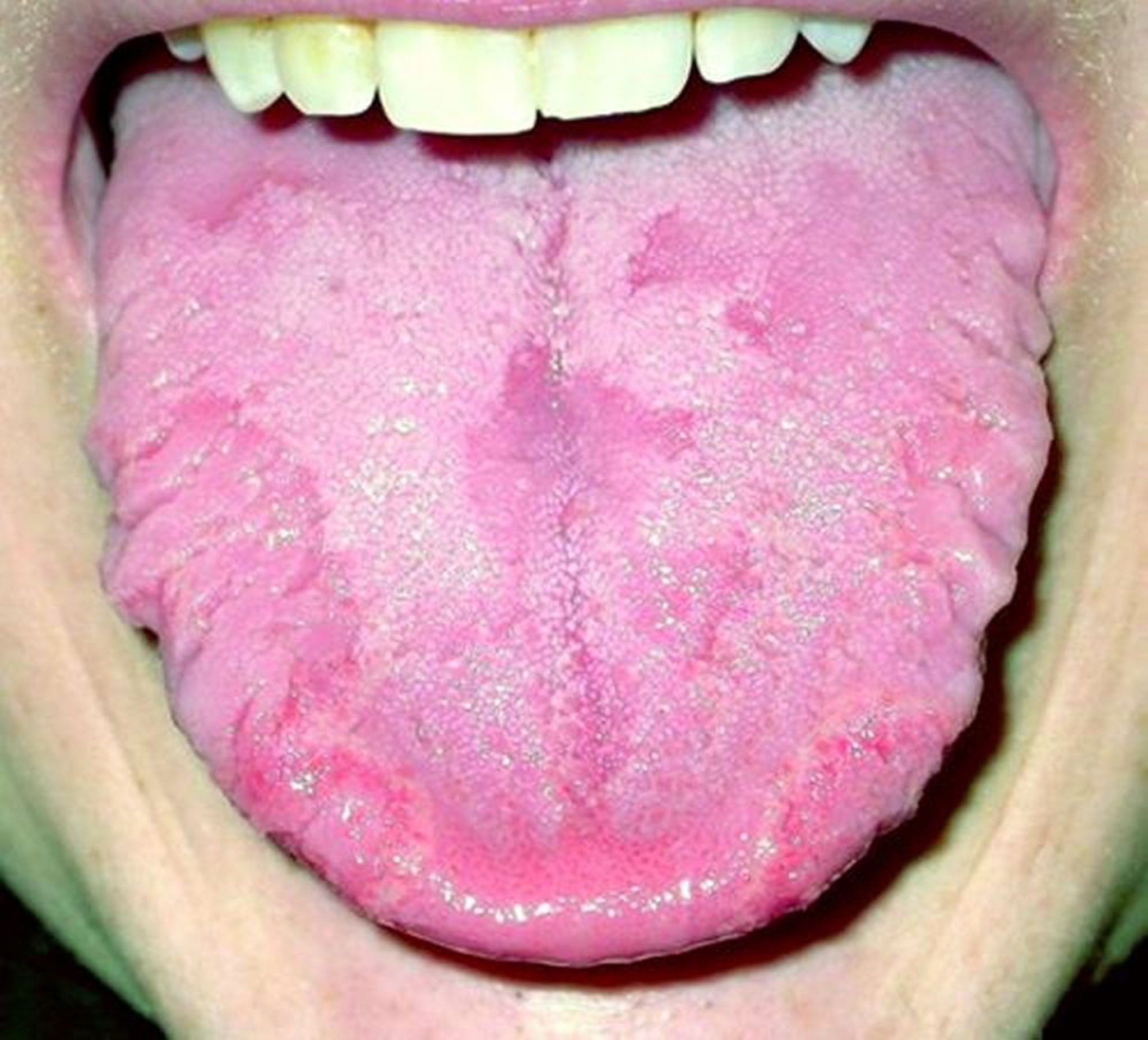 Lengua geográfica (con lengua fisurada)