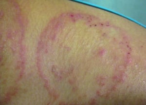 Tiña corporal (Tinea corporis) con un centro claro