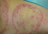 Teigne du corps (tinea corporis) s’éclaircissant au centre