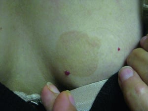 Brauner Fleck bei Tinea versicolor