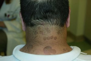 Placas castanhas de pitiríase versicolor no pescoço