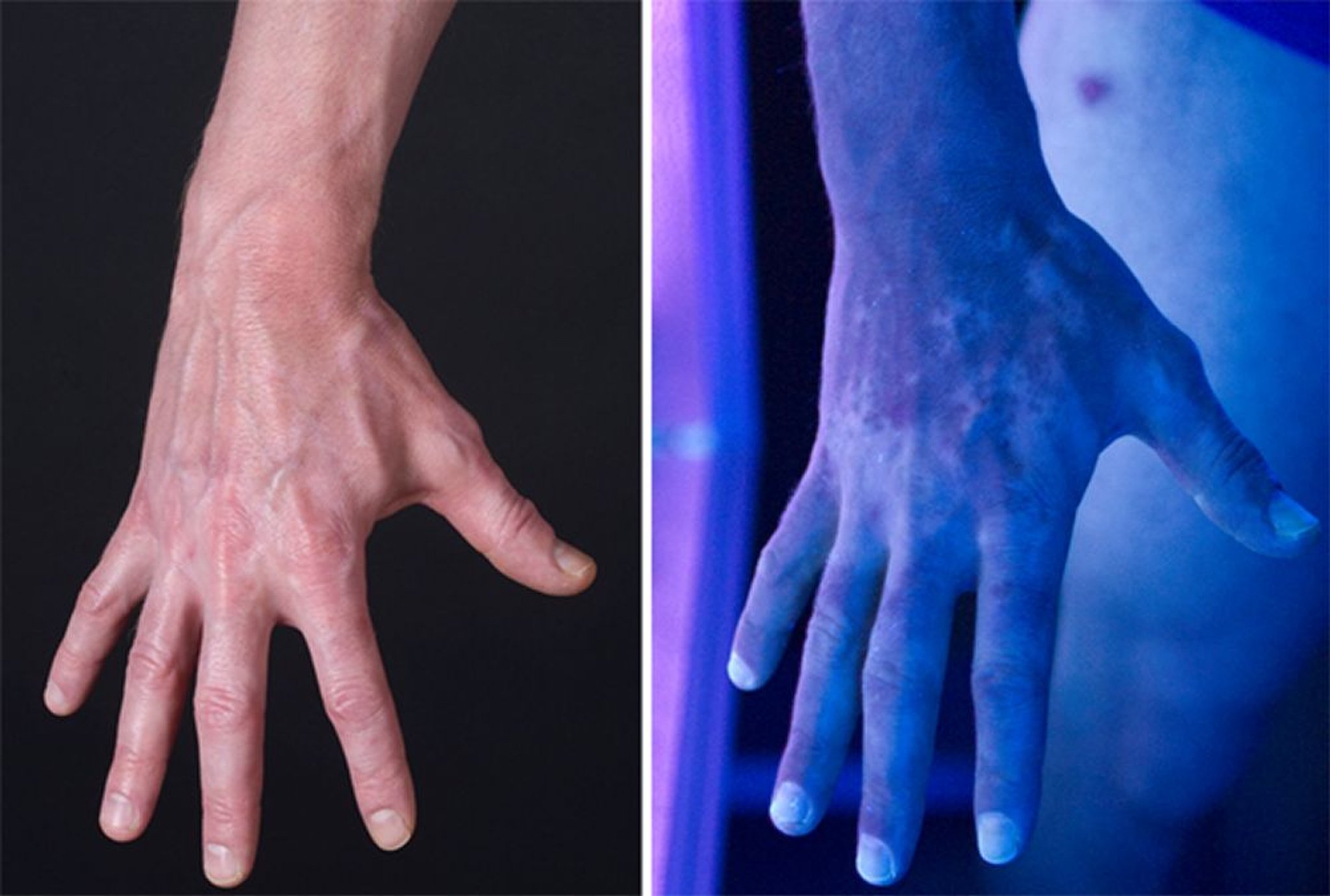 Vitiligo unter einer Wood-Lampe (fluoreszierendem Licht) gesehen