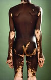 Vitiligo Contrasting With Dark Skin