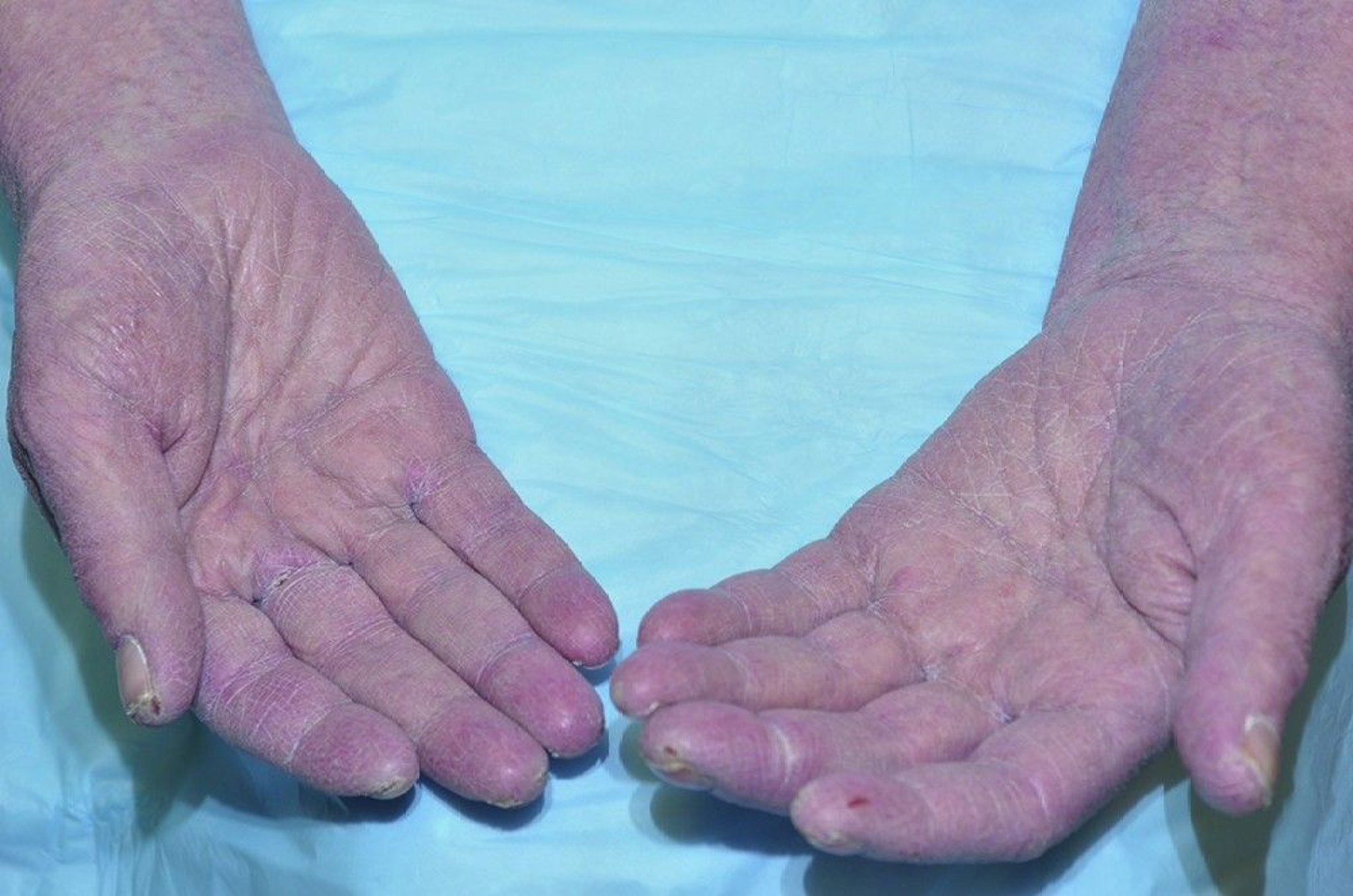 Xeroderma (Xerosis) of the Hands