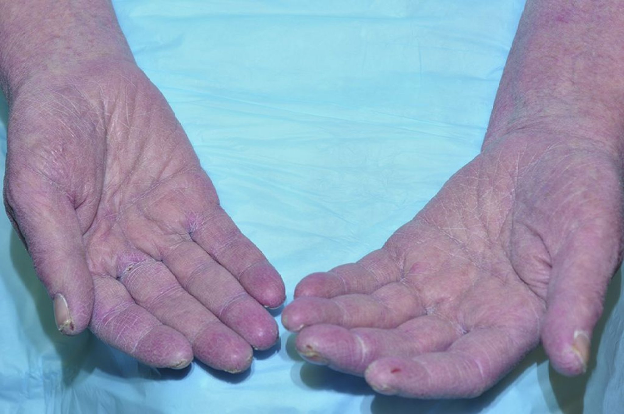 Xeroderma (xerosis) de las manos