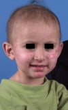 Acrodermatitis enteropathica bei einem Kind
