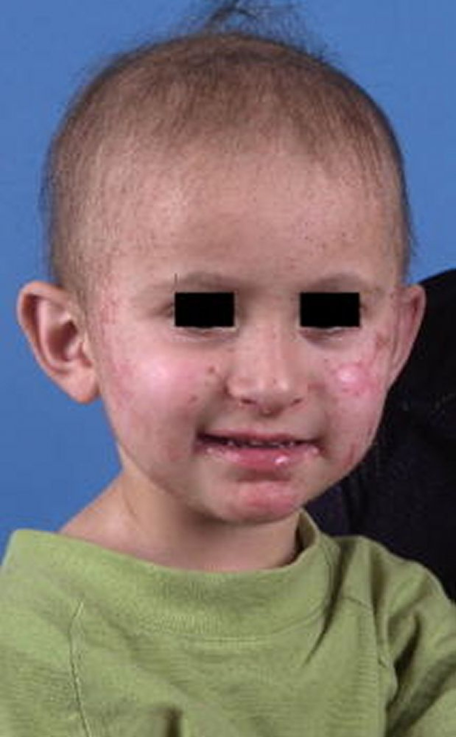 Acrodermatitis enteropática en un niño