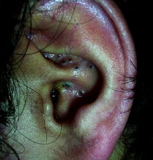 Points noirs dans l’oreille