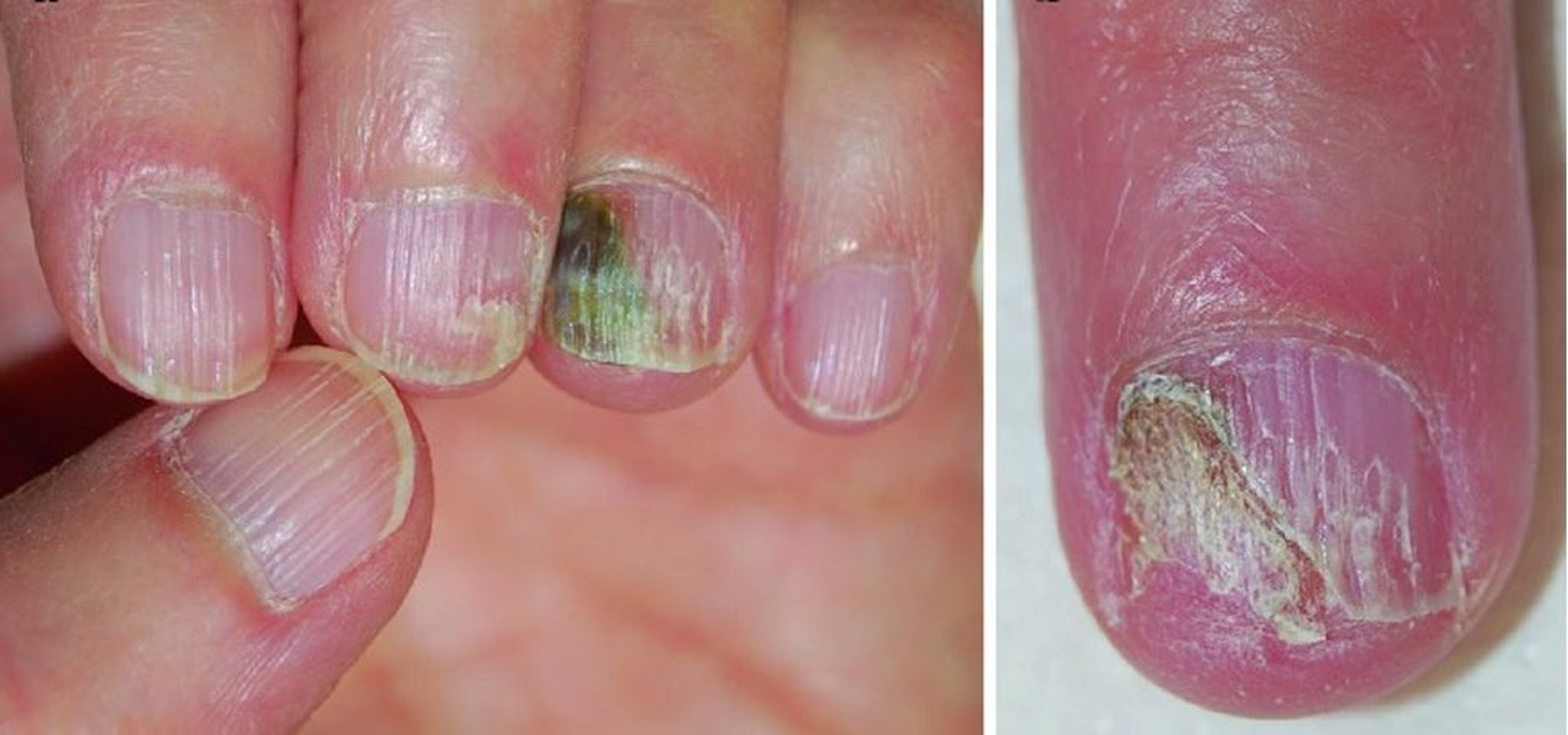 Syndrome des ongles verts