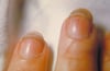 Endocarditis infecciosa (hemorragias en astilla)