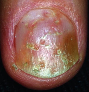 Psoriasis ungueal con picaduras y alteración de la coloración
