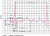 ECG: वेव्ज़ को पढ़ना