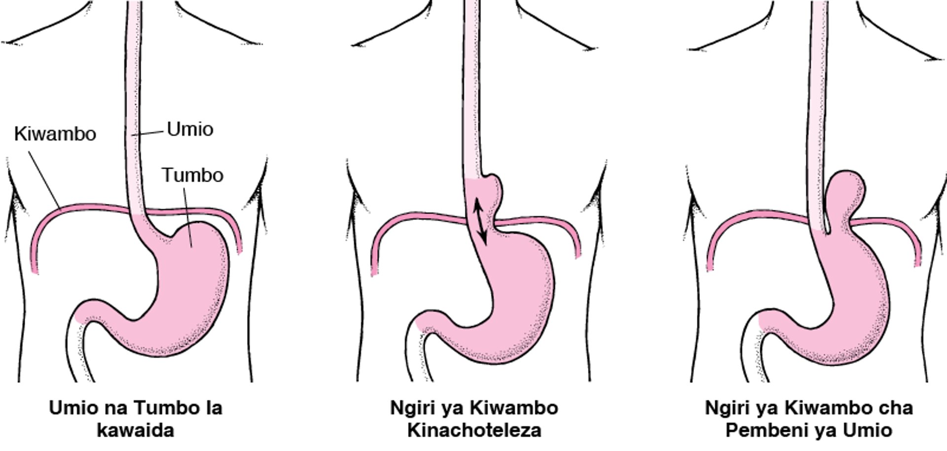 Kuelewa Ngiri ya Hiatasi