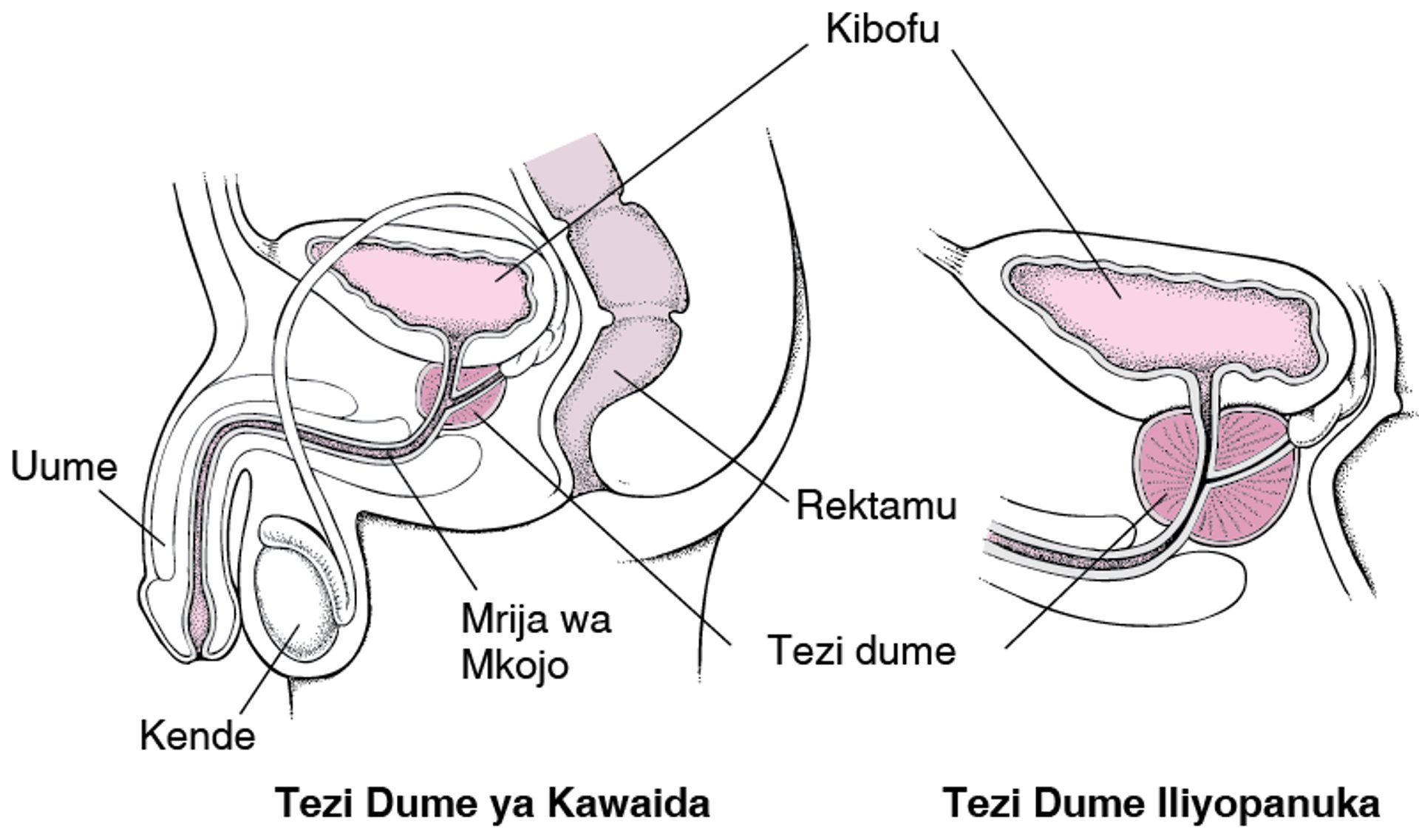 Ni Nini Hufanyika Wakati Tezi Dume Inaongezeka kwa Ukubwa?