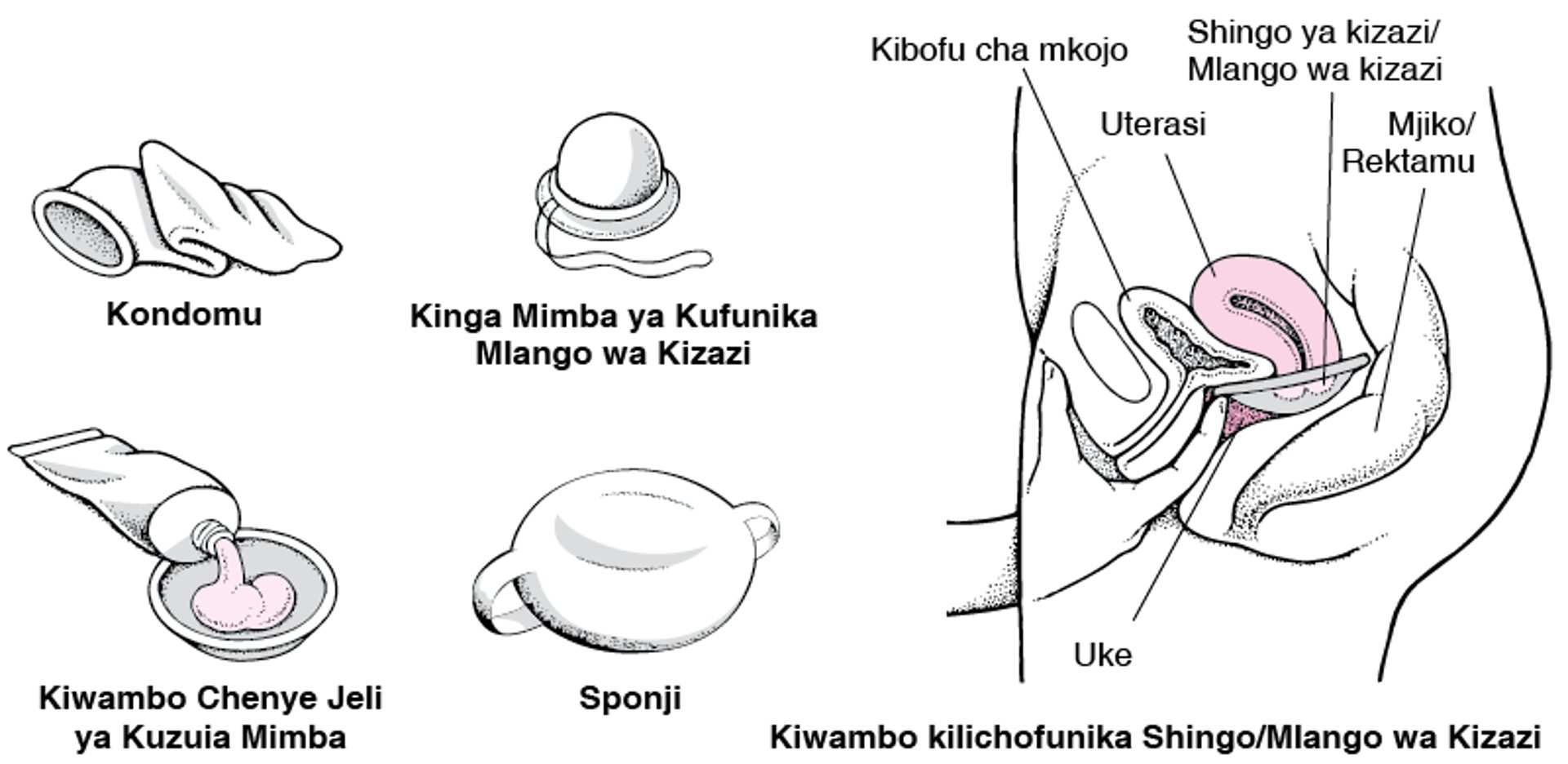 Kuzuia Ufikiaji: Uzuiaji Mimba kwa Kuzuia Mbegu za Kiume