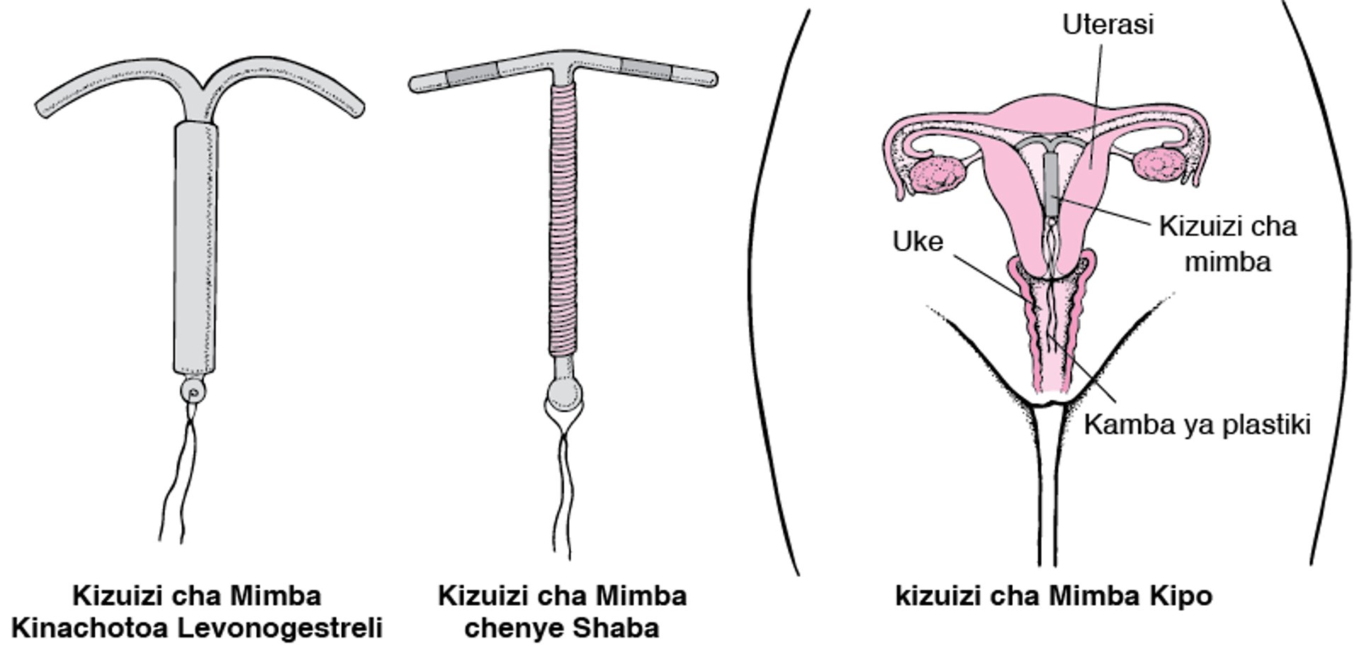 Kuelewa Vifaa Vinavyowekwa Ndani ya Uterasi