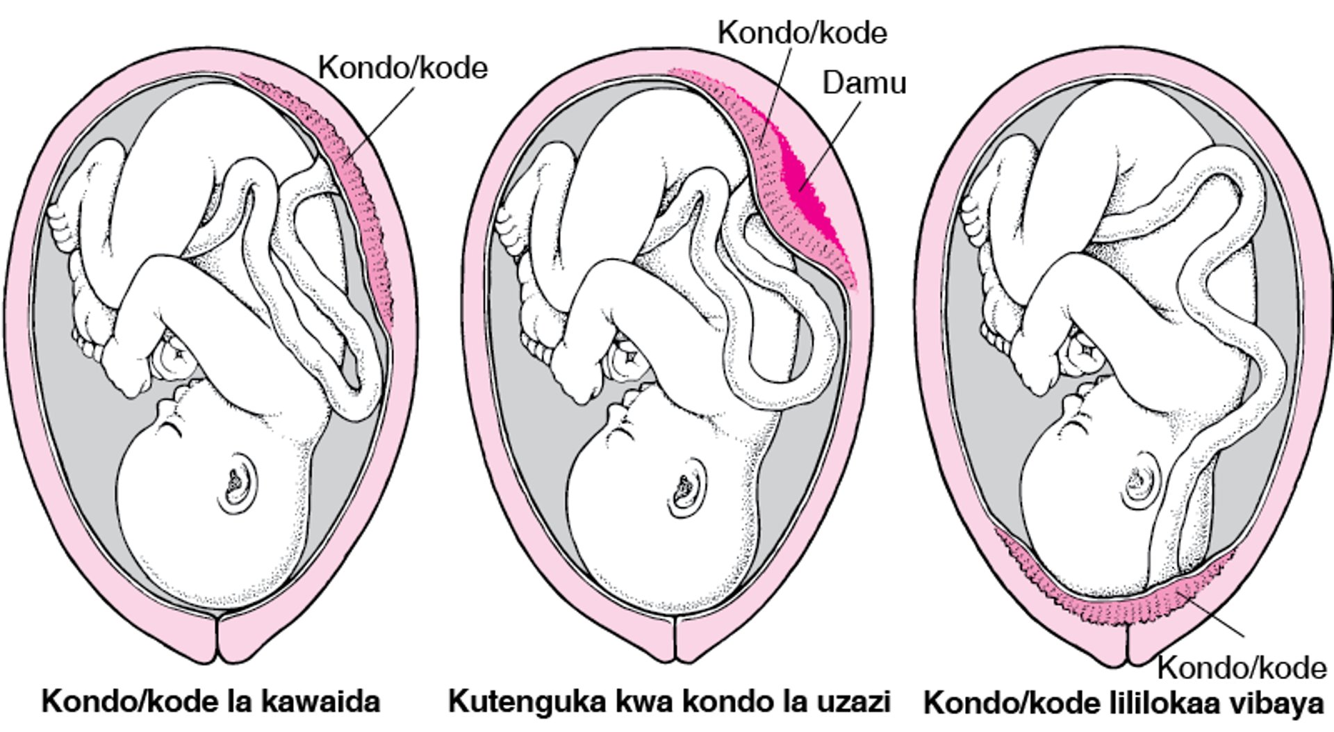 Matatizo ya Kondo la nyuma