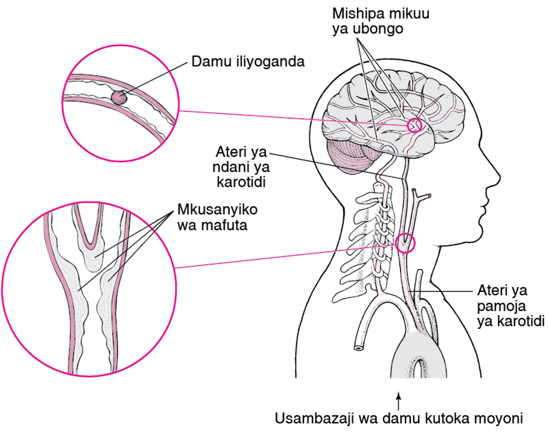 Milipuko na Mipasuko: Yanayosababisha Kiharusi cha Kuvuja Damu kwenye Ubongo