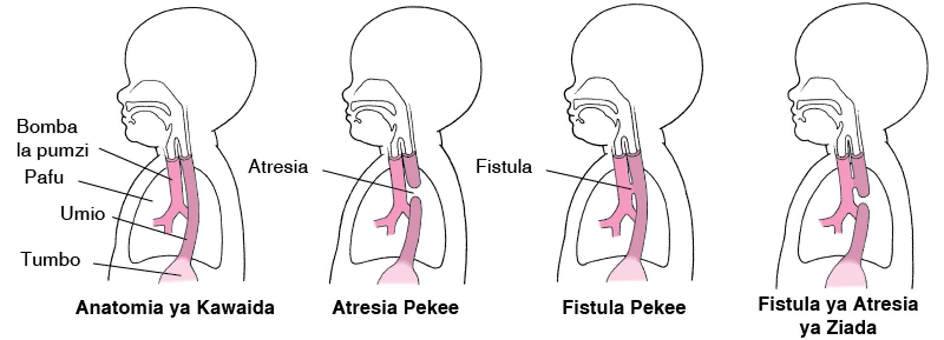 Atresia na Fistula: Kasoro kwenye Umio