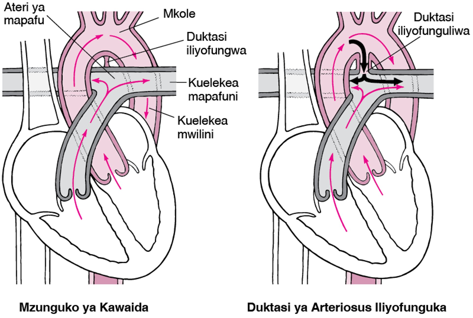 Daktasi ya Ateriosasi Iliyowazi: Kushindwa Kufunga