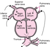 Truncus Arteriosus inayoendelea