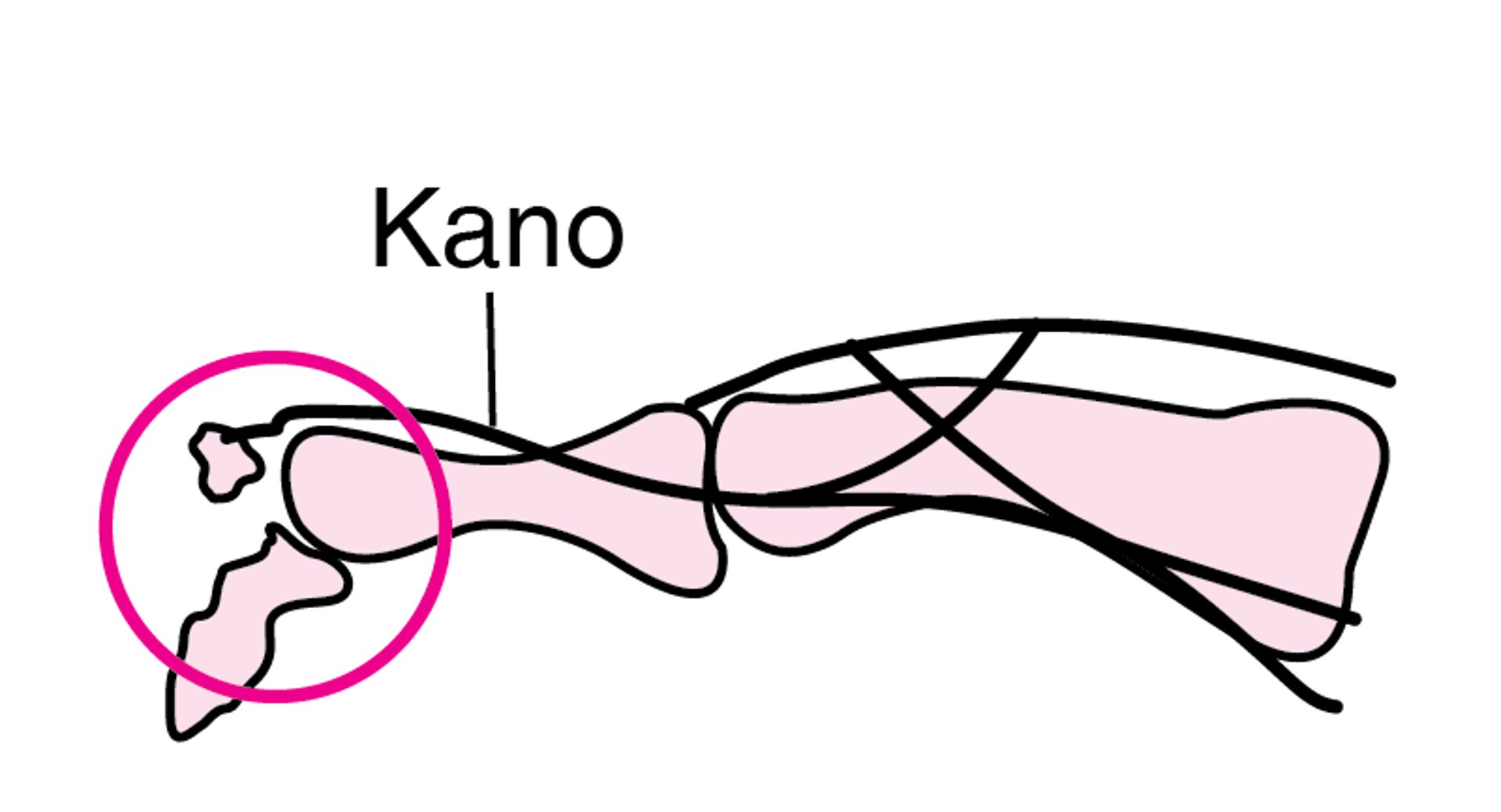 Kuachana kwa Mifupa ya Kidole