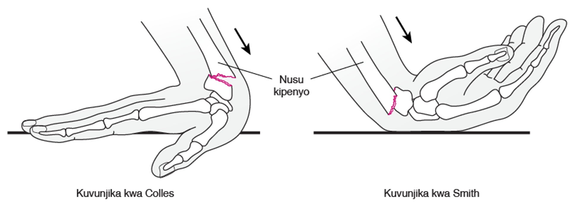 Mivunjiko ya Kifundo cha Mkono