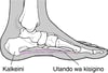 Uvimbe wa Plantar