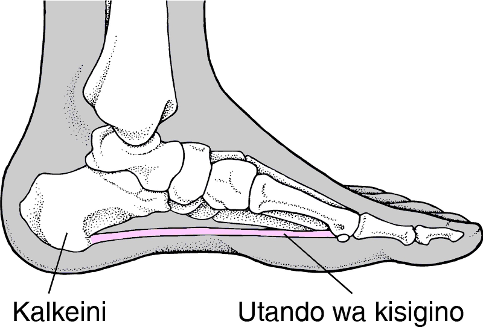 Uvimbe wa Plantar