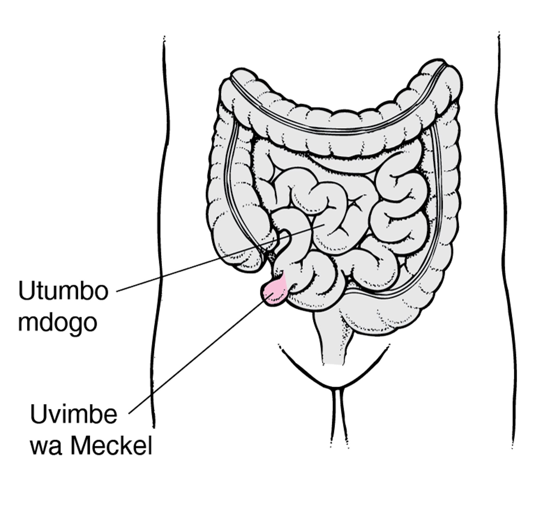 Uvimbe wa Meckel