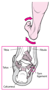 Kutegua Kifundo cha Mguu