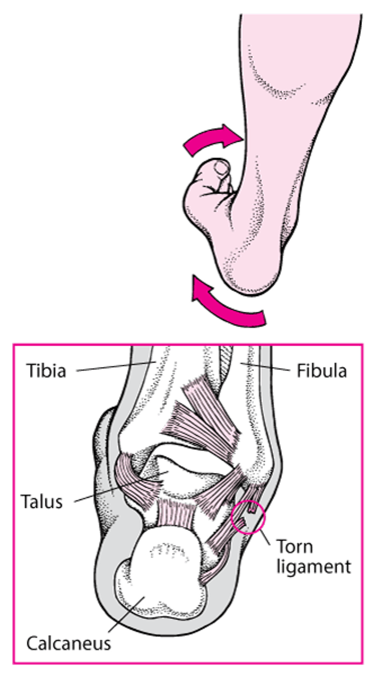 Kutegua Kifundo cha Mguu